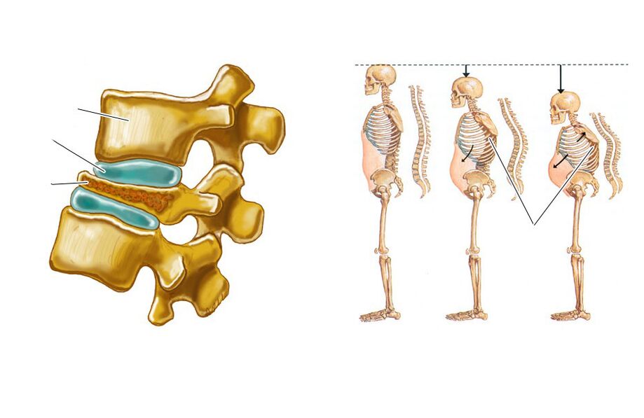 bíonn pian droma mar thoradh ar spine sagging