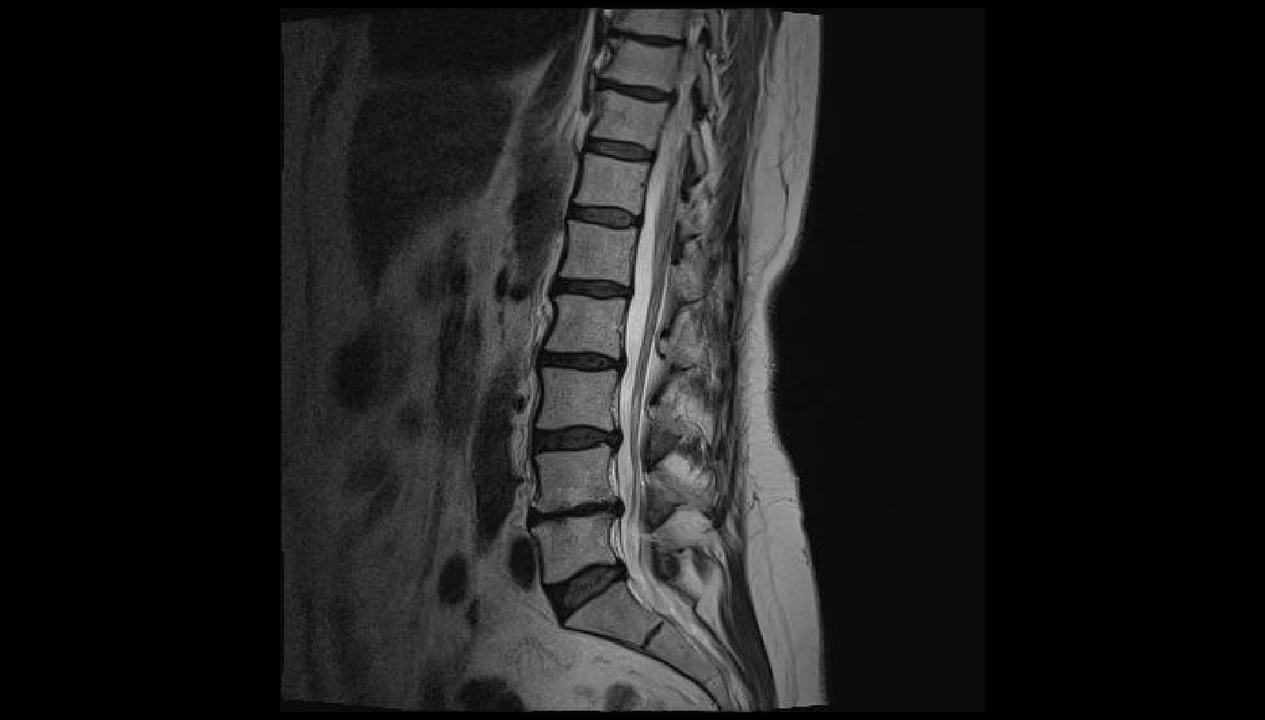 diagnóis pian ar ais sa réigiún lumbar