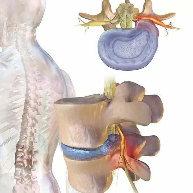 fadhbanna diosca intervertebral