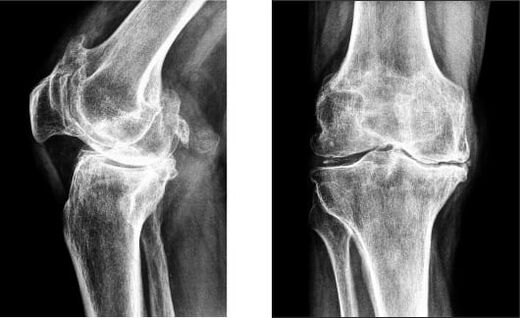 Gonarthrosis na glúine ar x-gha