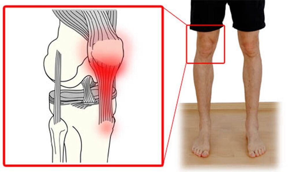 Tendinitis - athlasadh na tendons sa chomhpháirteach glúine