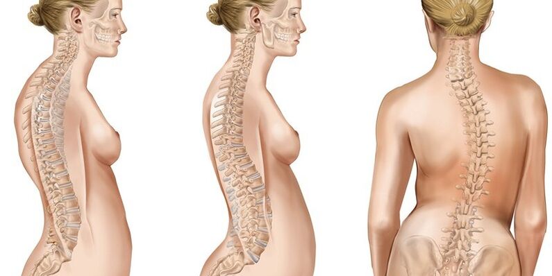 Spreagann scoliosis an spine chliabhraigh cuma pian sna lanna ghualainn