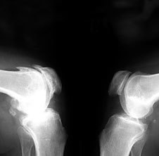 Osteoarthritis ar x-ghathaithe