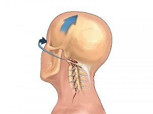 mar a léiríonn osteochondrosis an spine ceirbheacs é féin