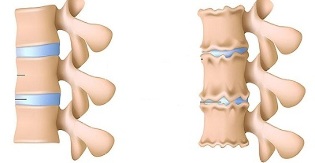 conas a aithint go bhfuil osteochondrosis an spine lumbar ann