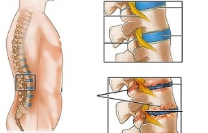 cúiseanna osteochondrosis an spine lumbar