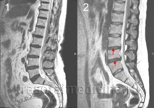 osteochondrosis an spine