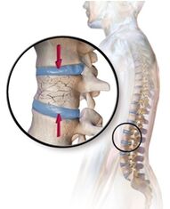 Spreagann oistéapóróis pian ar ais sa réigiún lumbar